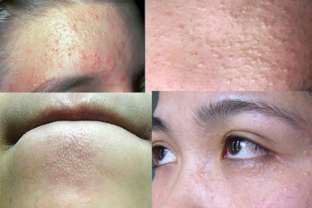 Góc làm đẹp: Mụn ẩn có tự hết không và bao lâu thì hết?